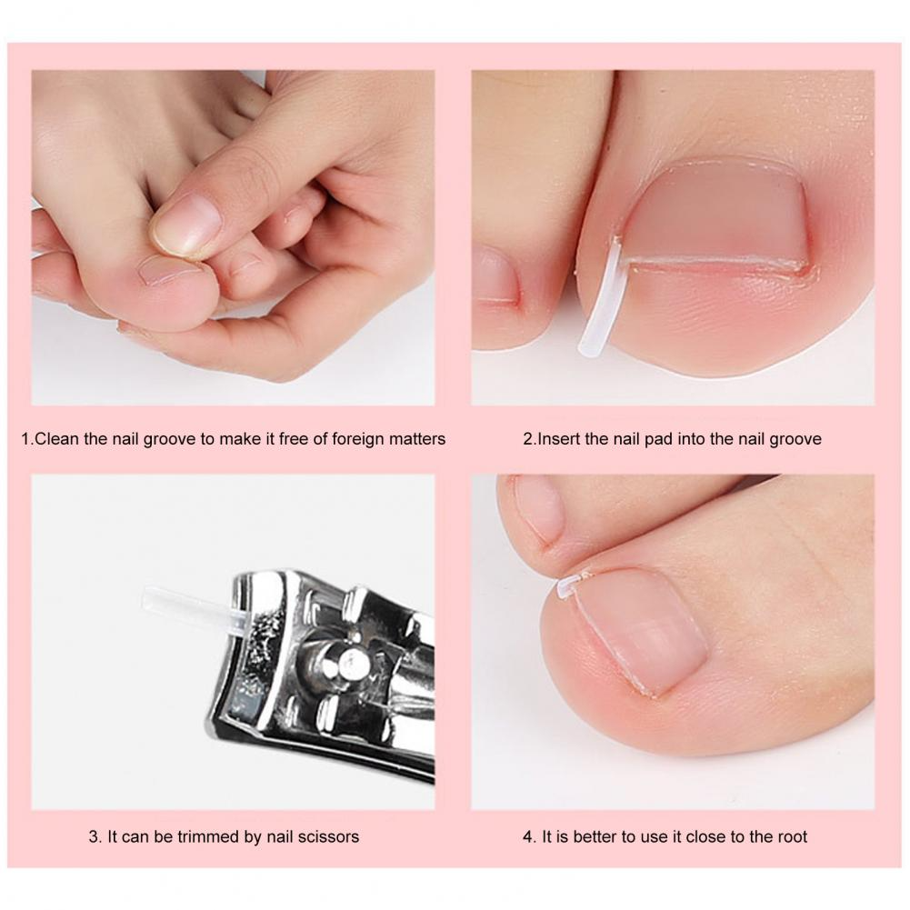 Diagram showing how the toenail support pad works