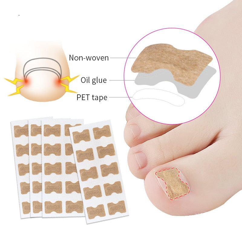 Close-up view of the discreet nail corrector sticker on a toe