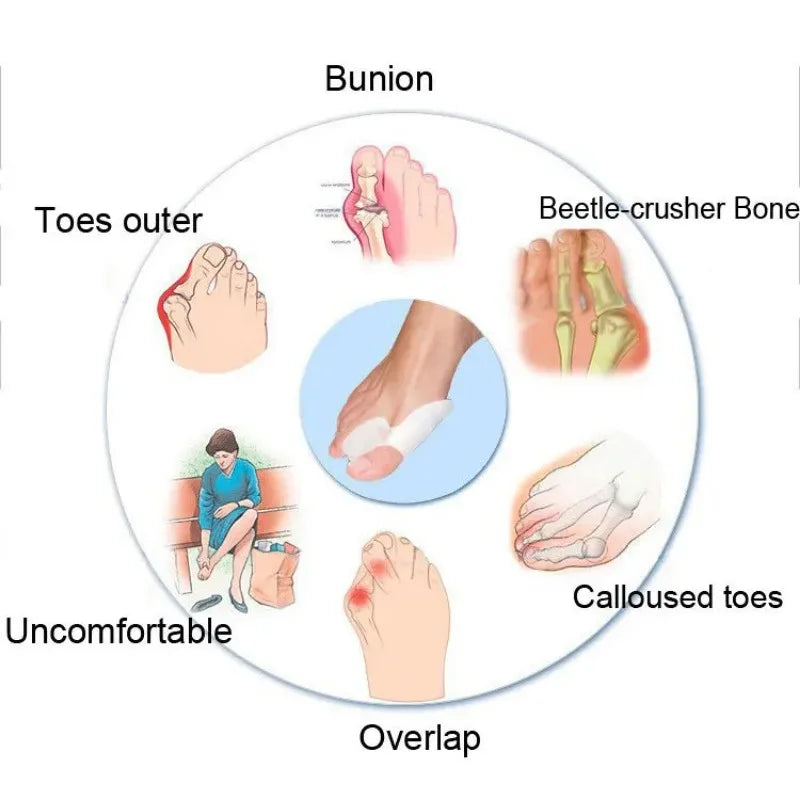 A user wearing the orthopaedic foot corrector to align their toes